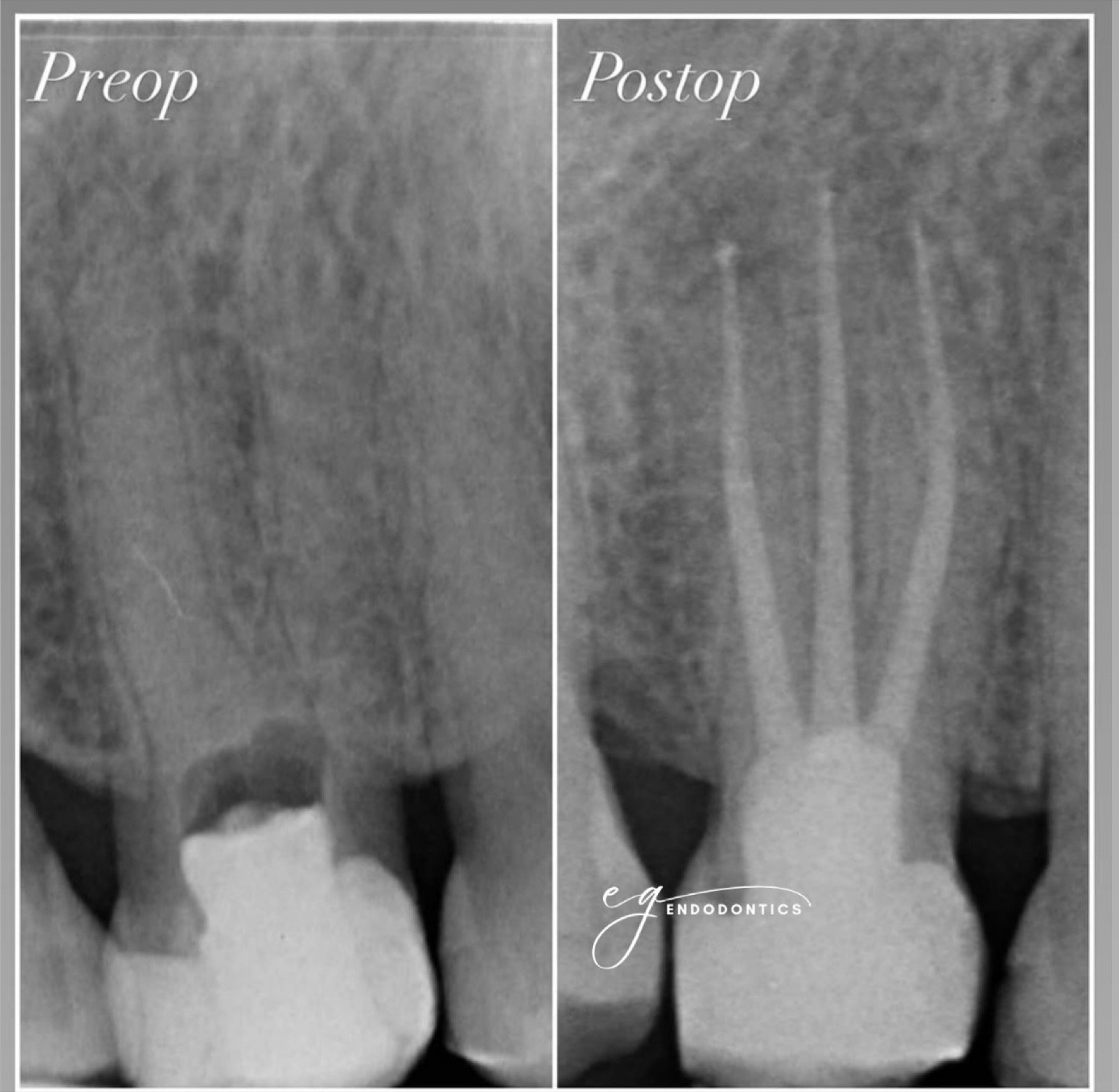 Management of a three-rooted premolar - radiographs