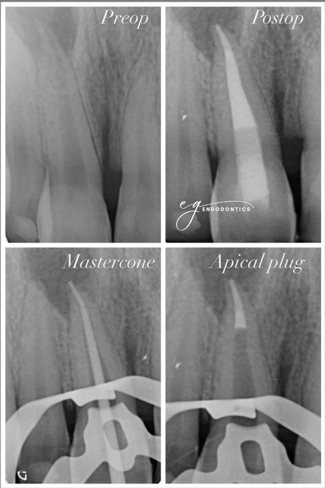 Apexification using bioceramic material - radiographs