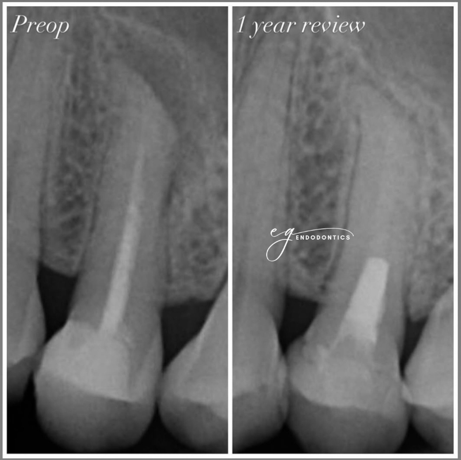 Complex retreatment - Biodentine apexification