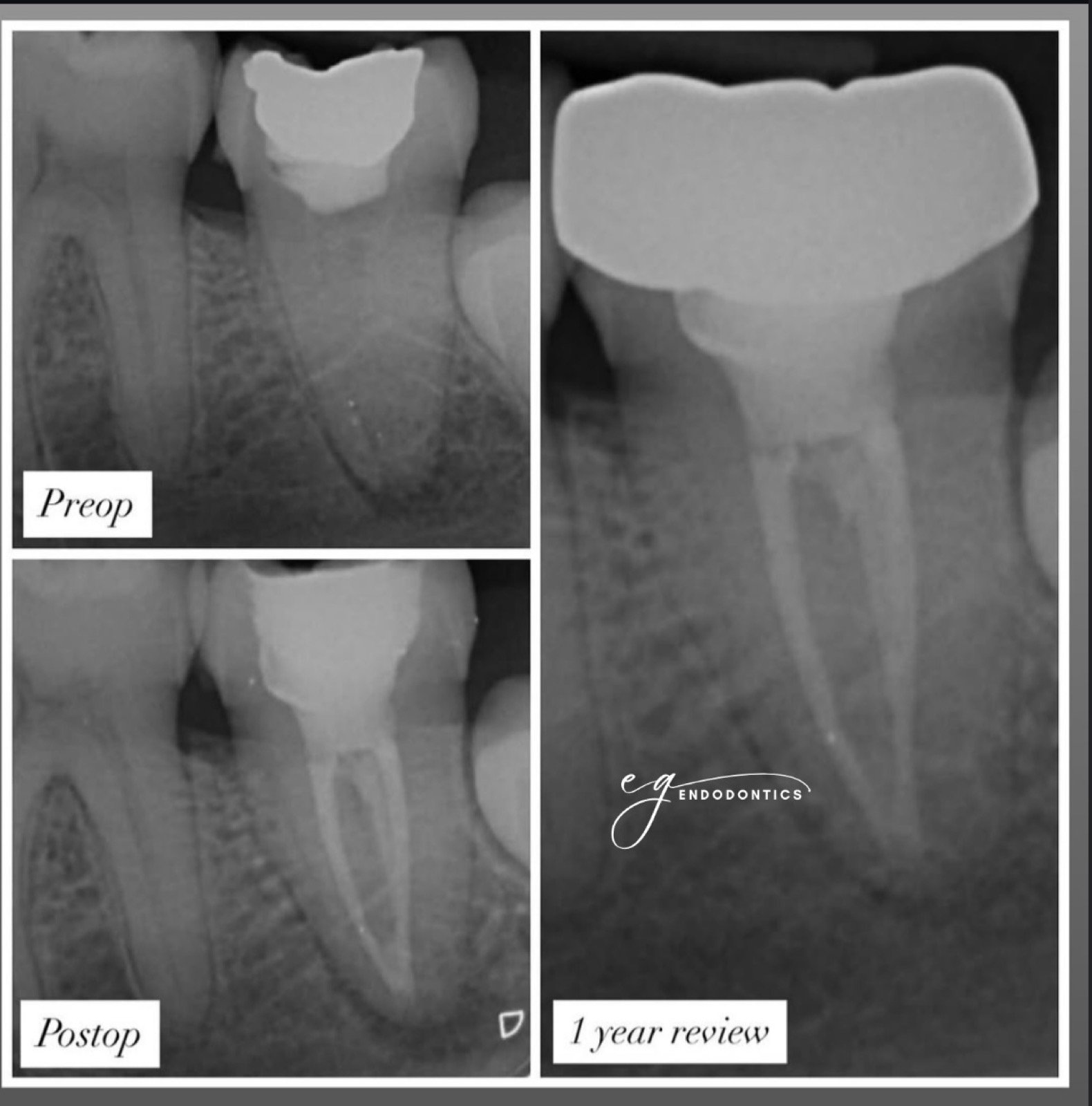 Management of a C-shaped canal - radiographs