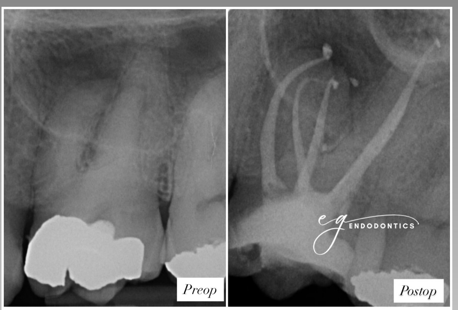 Calcified and severely curved MB2 canal - radiographs