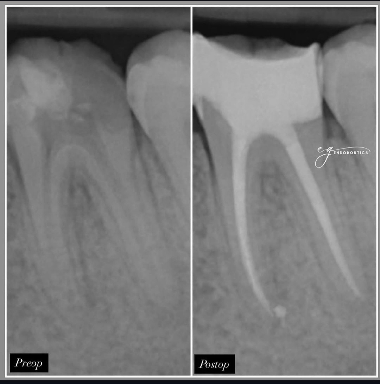 Management of cracked teeth and long curved roots - radiographs