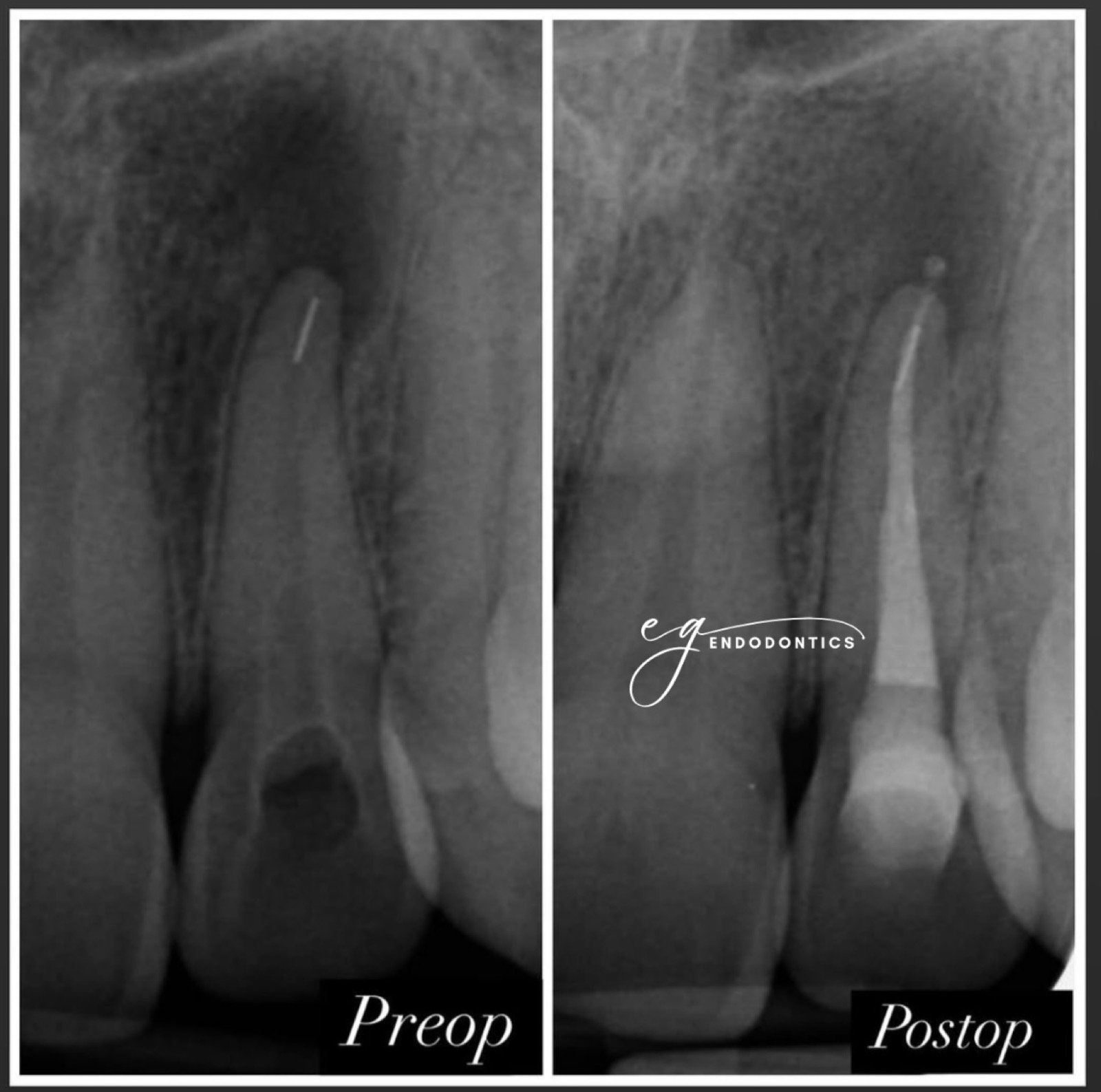 Management of a fractured instrument - radiographs