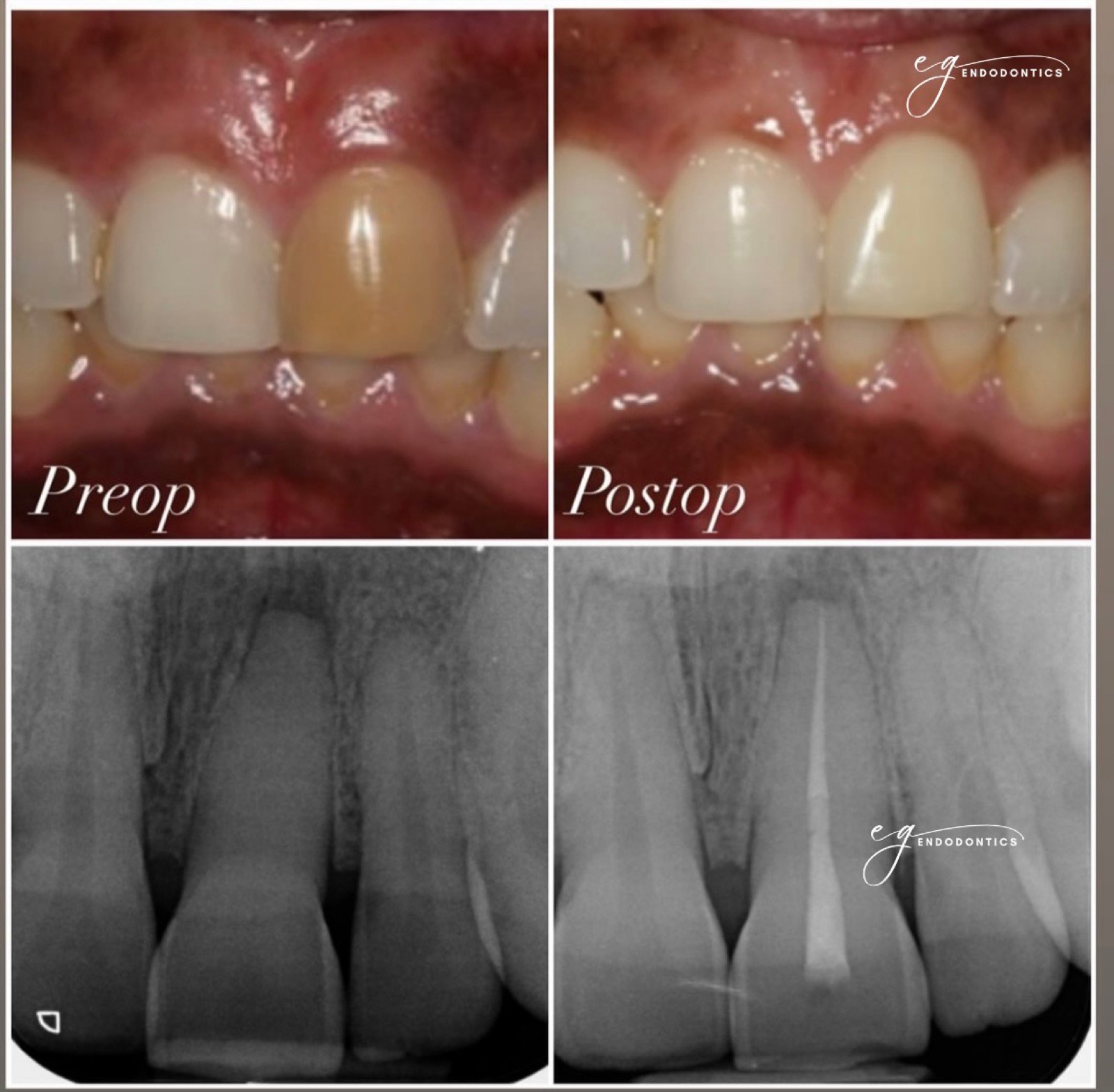 Internal bleaching case - before and after