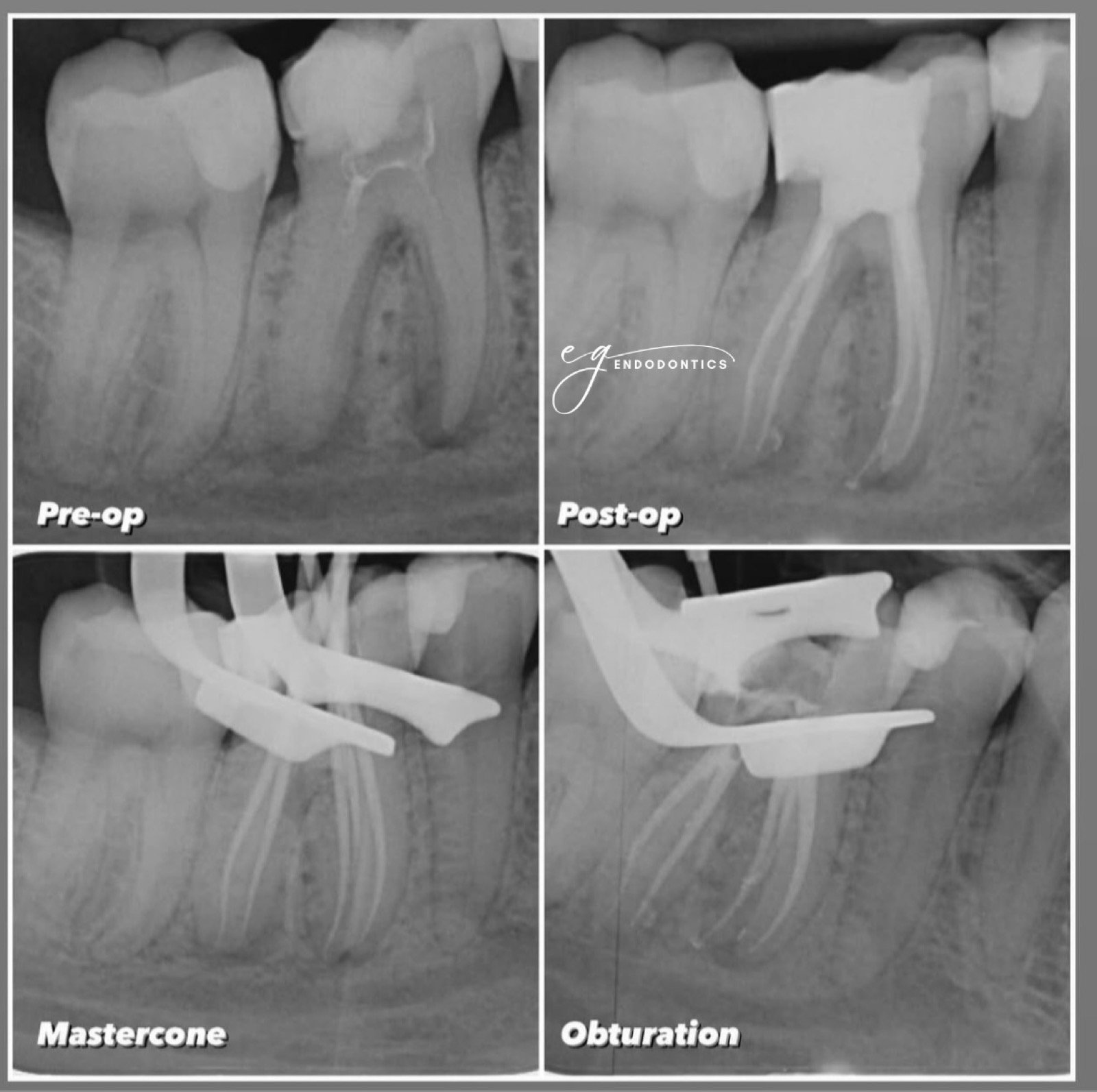 Management of a middle mesial canal - radiographs