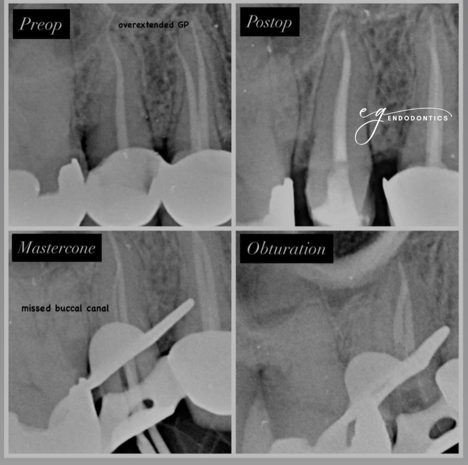 Retreatment - missed buccal canal