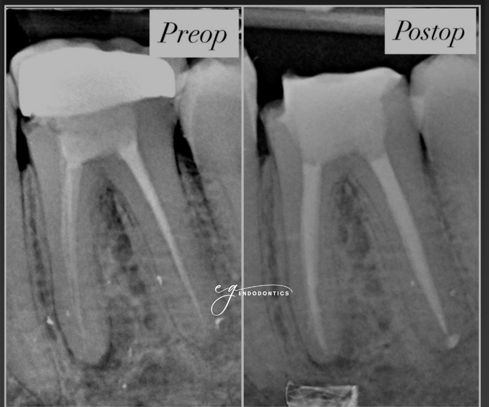 Retreatment - missed disto-lingual canal