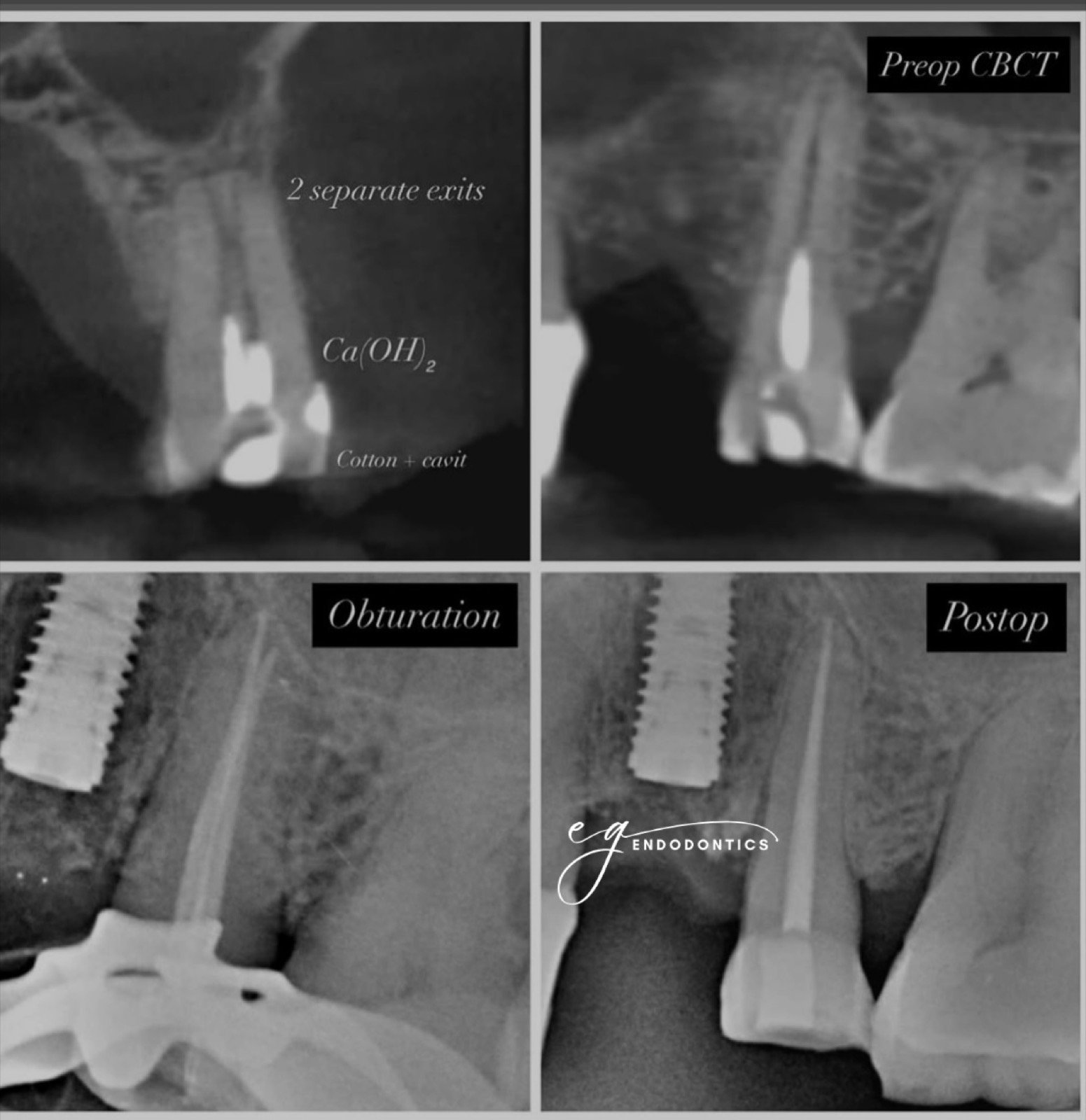 Retreatment - missed lingual canal