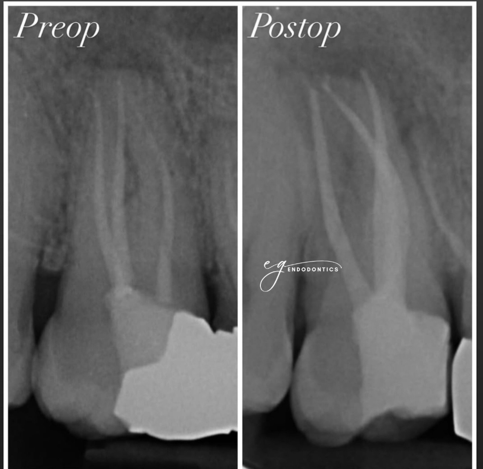 Retreatment - missed MB2 canal