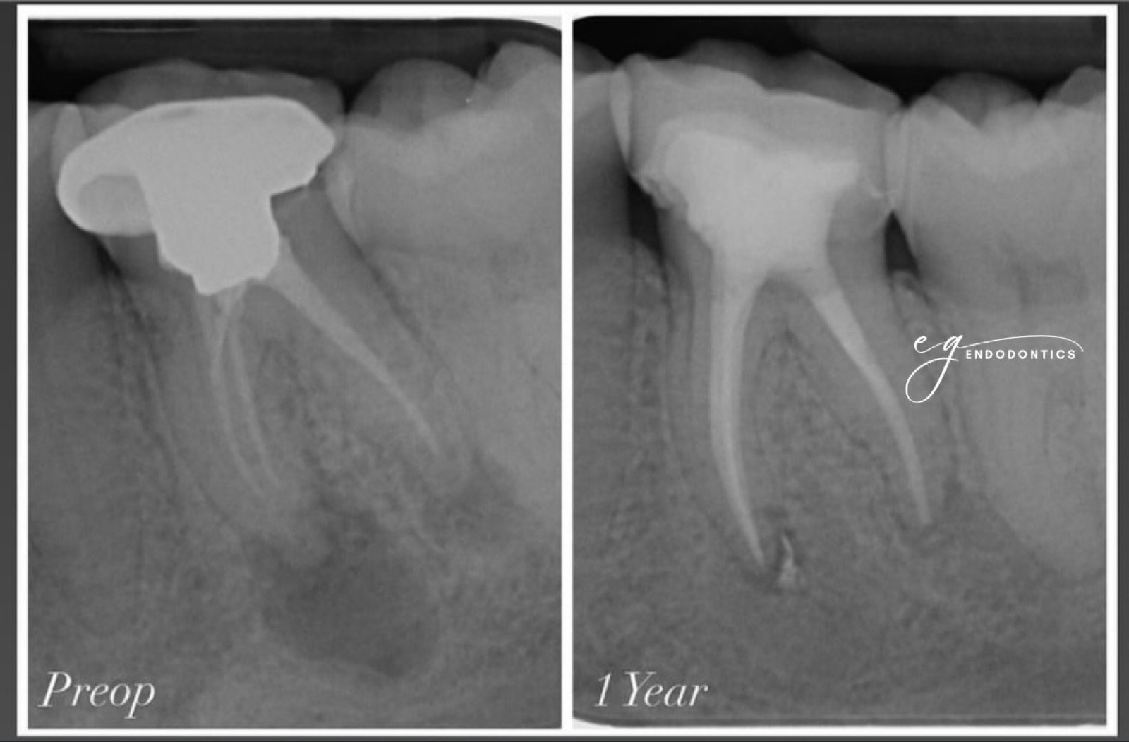 One-year recall after retreatment showing periapical healing