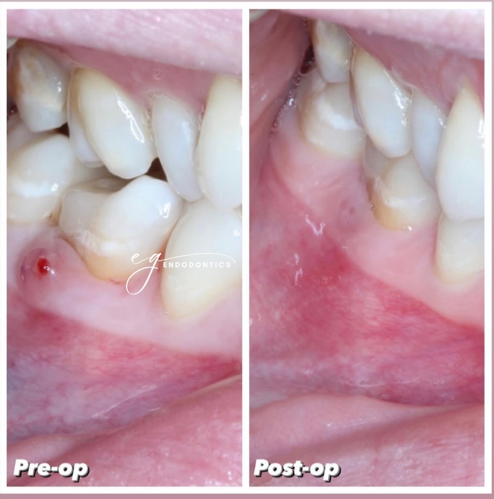 Sinus healing after root canal treatment